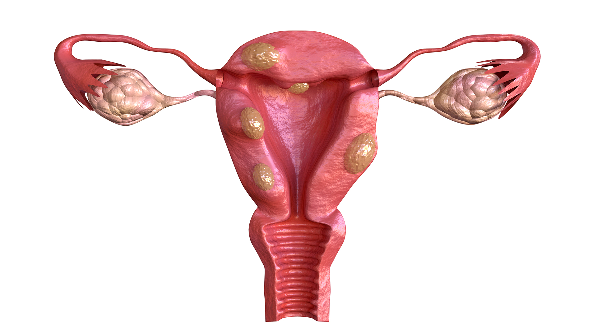 Os miomas intramurais se desenvolvem na camada intermediária do útero, o miométrio. (Foto: Freepik)
